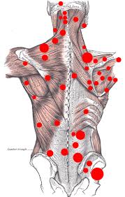 Trigger Points of the back