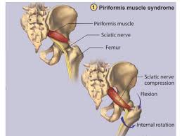 Piriformis syndrome and treatment options - Dr. Zatrok's blog