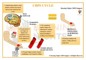 What-is-CRPS-CRPS-cycle-BN-1024x724